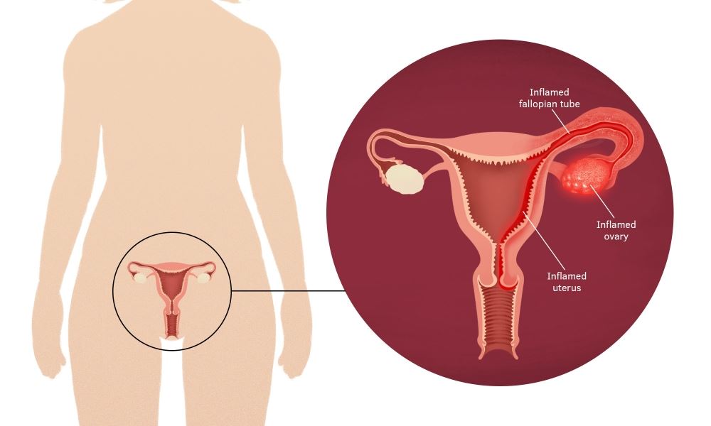 how does PID cause infertility in women?