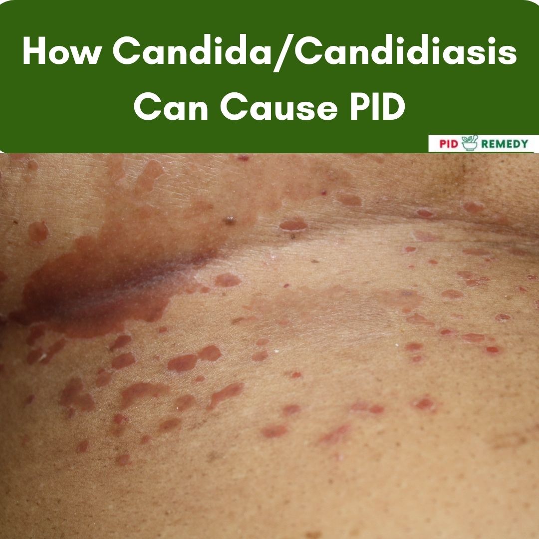 How Candida/Candidiasis Can Cause PID